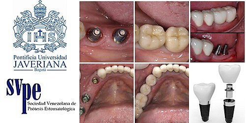 Dr. Cesar Valero, Implante Dental y Prótesis