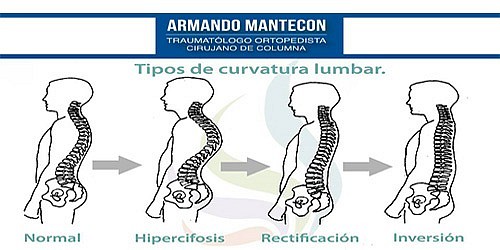 Cirujano de Columna en Cancún Dr. Armando Mantecon