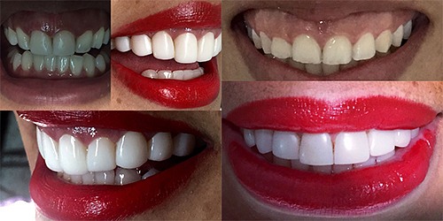 FUERZA DENTAL