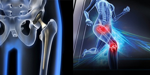PROTESIS DE CADERA Y RODILLA EN CANCUN DR. LUIS GARCIA ANAYA