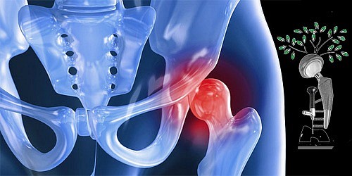 PROTESIS DE CADERA Y RODILLA EN CANCUN DR. LUIS GARCIA ANAYA