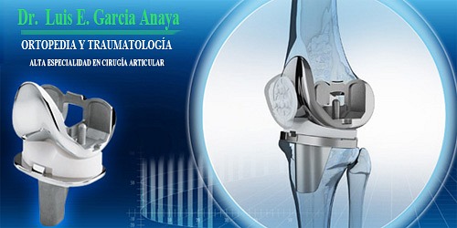 PROTESIS DE CADERA Y RODILLA EN CANCUN DR. LUIS GARCIA ANAYA