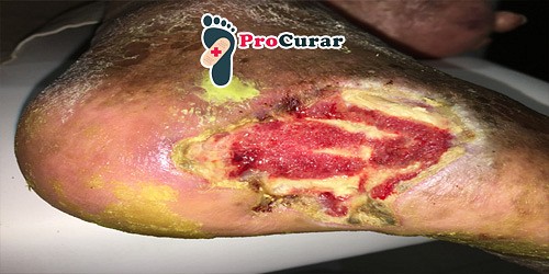 PIE DIABETICO Y HERIDAS EN CANCUN DR. ALFREDO MENA GEDED
