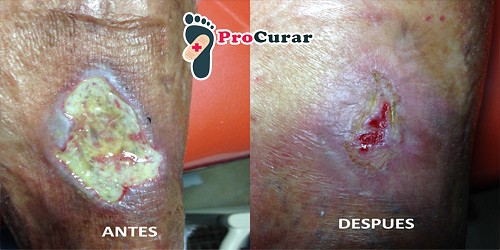 PIE DIABETICO Y HERIDAS EN CANCUN DR. ALFREDO MENA GEDED