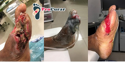 PIE DIABETICO Y HERIDAS EN CANCUN DR. ALFREDO MENA GEDED