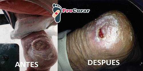 PIE DIABETICO Y HERIDAS EN CANCUN DR. ALFREDO MENA GEDED