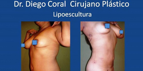 Dr. Diego Coral Cirujano Plástico