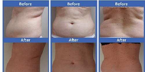 The Slimming Zone