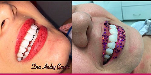 Periodoncia - Implantes - Blanqueamiento Dra. Andry Garcia 