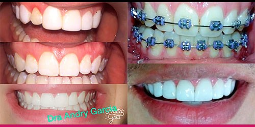 Periodoncia - Implantes - Blanqueamiento Dra. Andry Garcia 