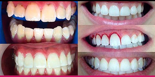Periodoncia - Implantes - Blanqueamiento Dra. Andry Garcia 