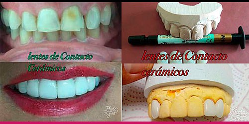 Periodoncia - Implantes - Blanqueamiento Dra. Andry Garcia 