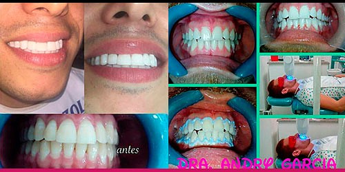Periodoncia - Implantes - Blanqueamiento Dra. Andry Garcia 