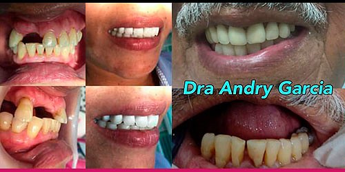 Periodoncia - Implantes - Blanqueamiento Dra. Andry Garcia 