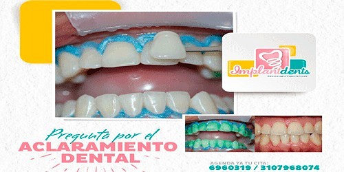 Odontologia Implantdents