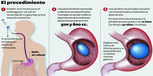 GASTROCIRUGIA Y OBESIDAD EN CANCUN DR. ROBERTO CISNEROS 