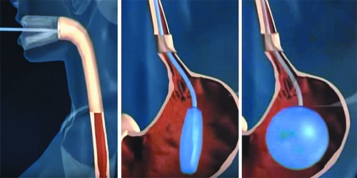 GASTROCIRUGIA Y OBESIDAD EN CANCUN DR. ROBERTO CISNEROS 