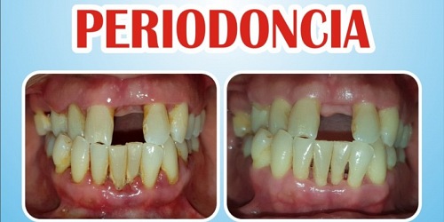 DentiLaser Odontología sin Dolor en Ecuador