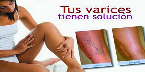 VARICES Y ESCLEROTERAPIA EN CANCUN DR. GILBERTO URBINA