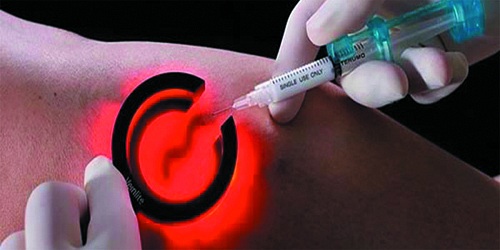 VARICES Y ESCLEROTERAPIA EN CANCUN DR. GILBERTO URBINA