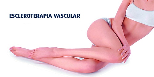 VARICES Y ESCLEROTERAPIA EN CANCUN DR. GILBERTO URBINA