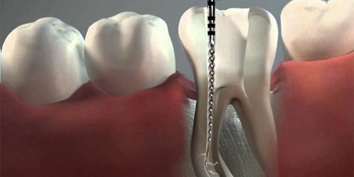 DENTAL SOL Endodoncia