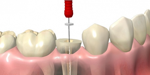 DENTAL SOL Endodoncia