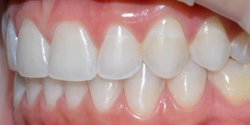 Odontocalidad